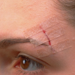 3M SteriStrip* Blendtone Wundnahtstreifen 6 x 75 mm